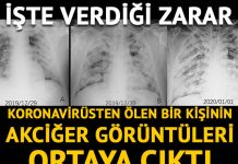 Koronavirüsün akciğerlere verdiği zararı gösteren röntgen ve tomografi görüntüleri ortaya çıktı