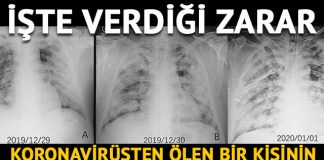 Koronavirüsün akciğerlere verdiği zararı gösteren röntgen ve tomografi görüntüleri ortaya çıktı