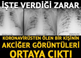 Koronavirüsün akciğerlere verdiği zararı gösteren röntgen ve tomografi görüntüleri ortaya çıktı